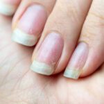 Nail White Spots? Discover  Causes And Secrets To Healthy Nails
