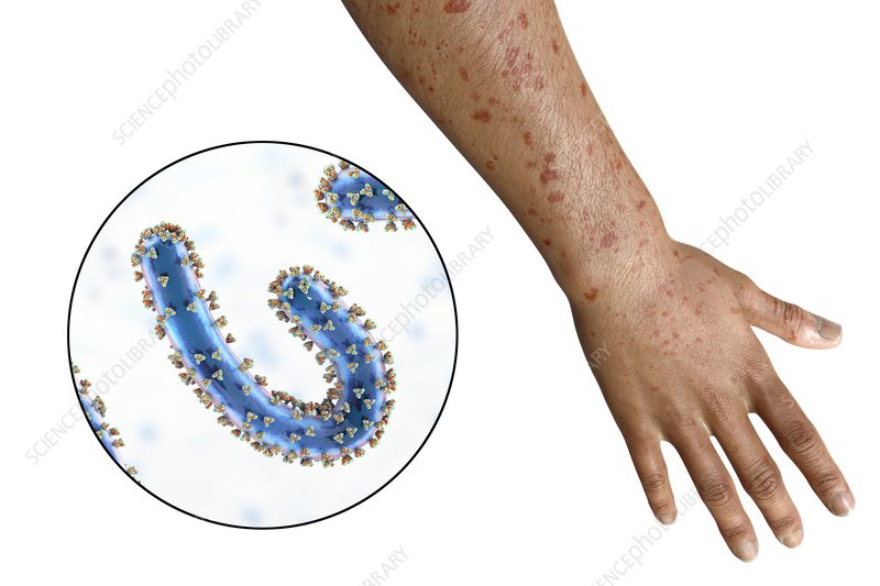 Marburg Virus That You Should Know