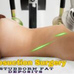 What You Need to Know About Liposuction Surgery