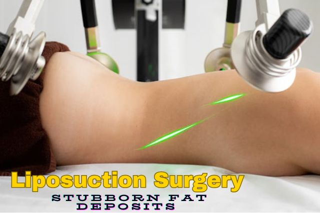 What You Need to Know About Liposuction Surgery